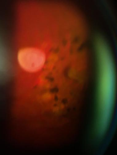 Retinal tear - horsehoe shaped - after laserphotocoagulation